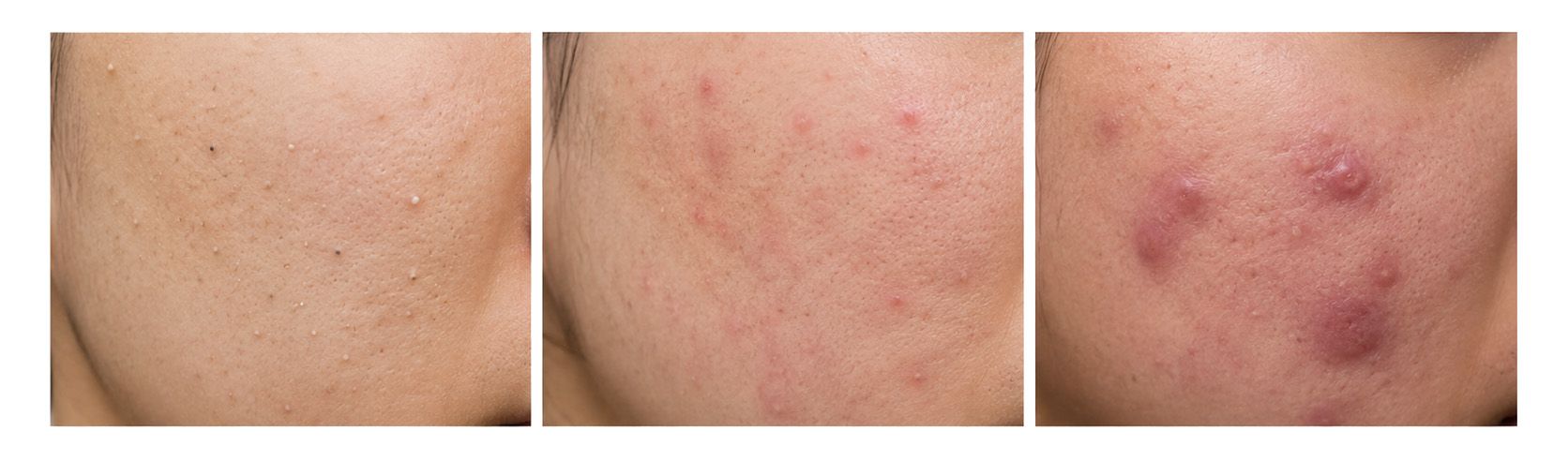 Songdo Human Dermatology_comparison of acne types