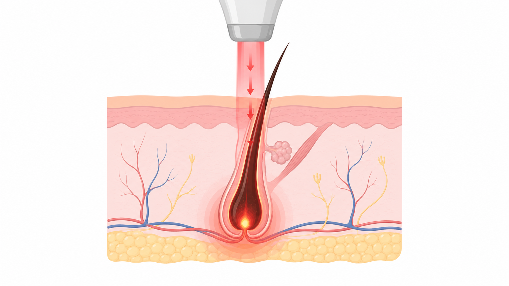 Songdo Human Dermatology_how laser hair removal works