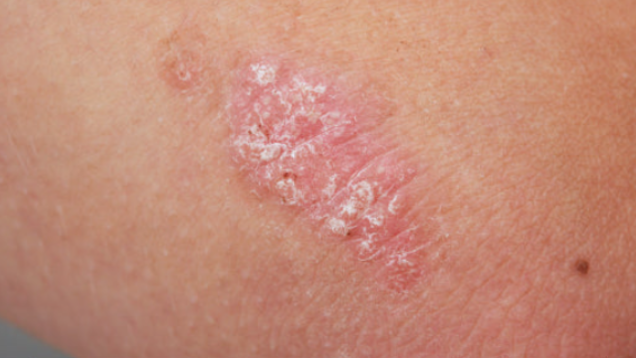 Psoriasis Treatment in Songdo, Incheon | Songdo Human Dermatology