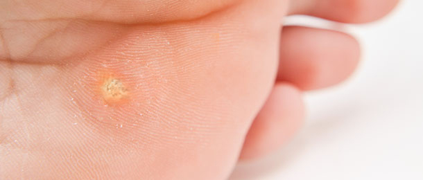Wart and Corn Treatment in Songdo, Incheon | Songdo Human Dermatology